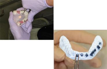 3D Baskılı Modeller Kullanılarak Nasıl Diş Telleri Yerleştirilir?.