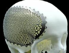 Farsoon Technologies'in 3D Yazıcıları İle Ameliyat Öncesi Prova İmkanı&Hastaya Özel İmplant Üretimi.